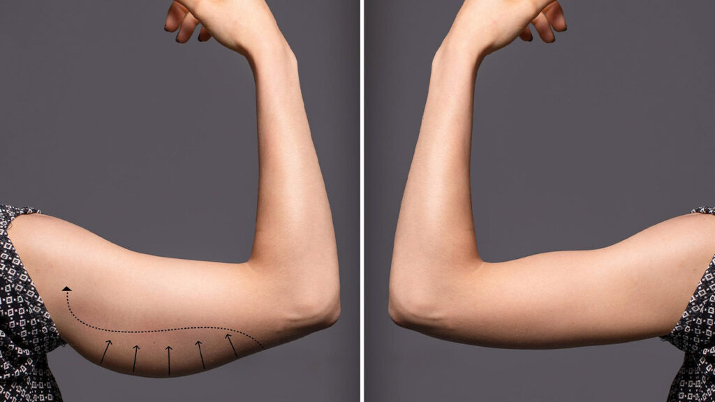 tonificar tus brazos